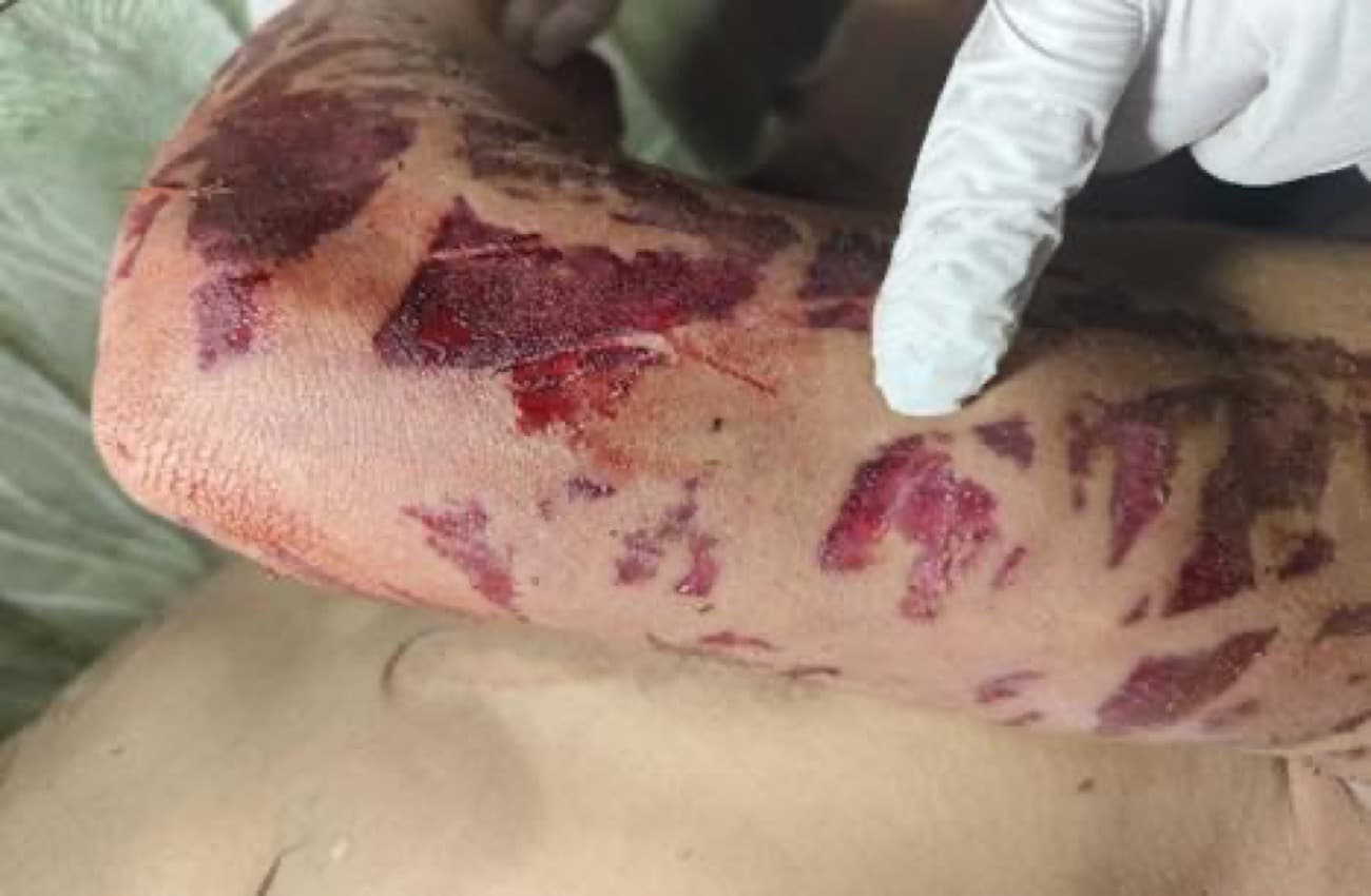 Farmer dies from snake bite in Bukidnon town