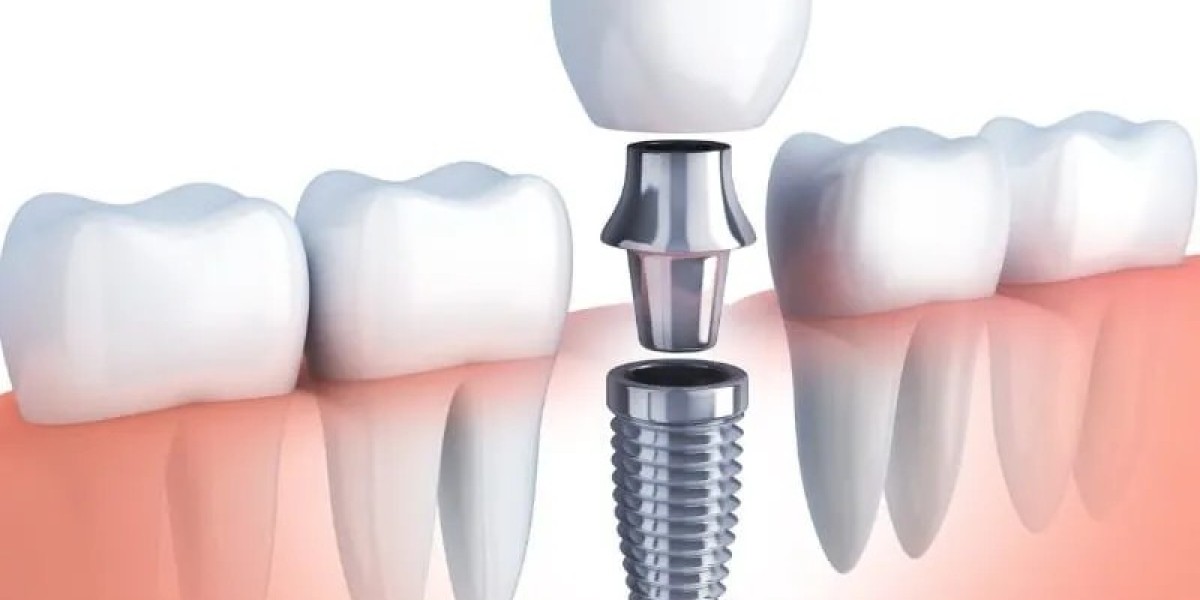 Transform Your Smile with Dental Implants Services in McKinney, TX