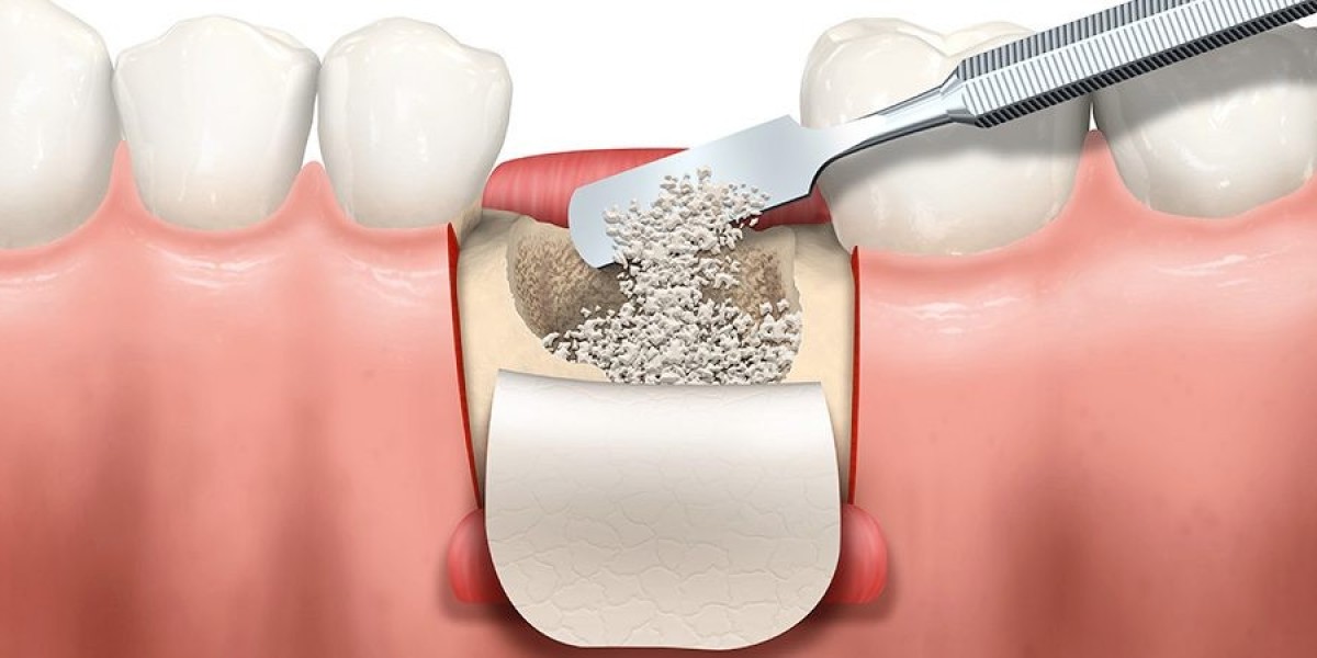 Dental Bone Graft Substitute Market Trends, Size, Segments, Emerging Technologies and Forecast by 2030