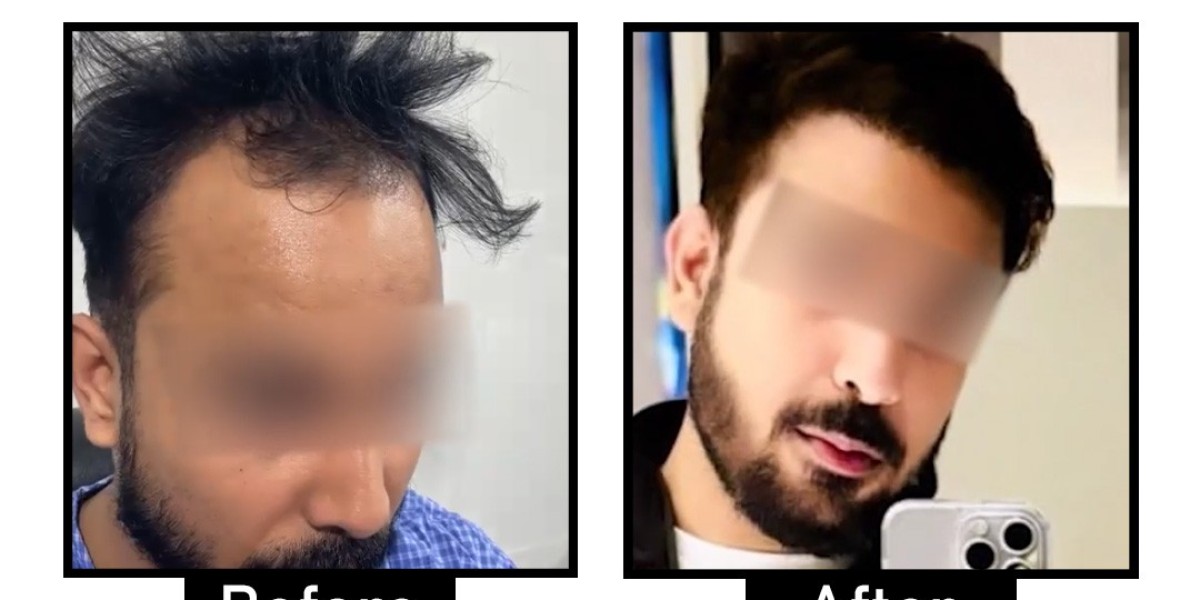 Get the Best Hair Transplant in Delhi for Natural-Looking Hair